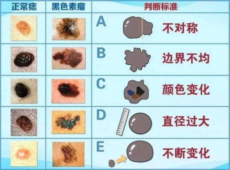 看似不起眼却能致命！会癌变的“痣”，有这5个特征